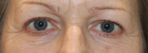 Upper blepharoplasty before AP view e 1505924161605