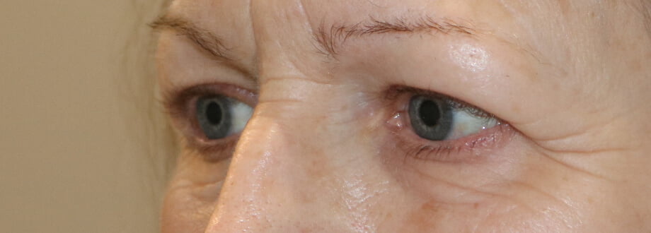 Upper blepharoplasty before left oblique