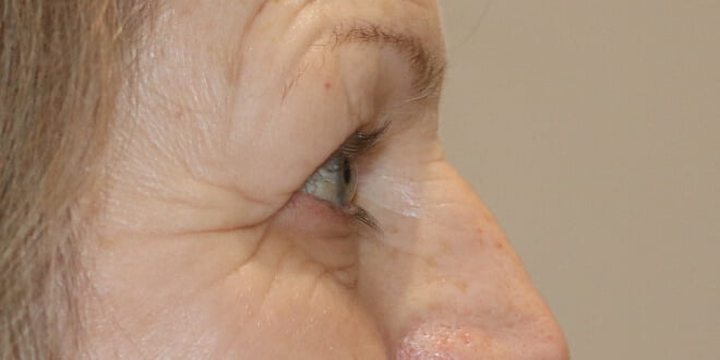 Upper blepharoplasty before right lateral