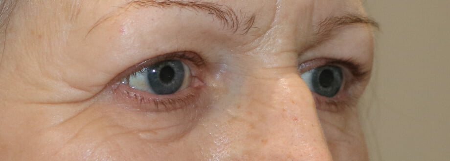 Upper blepharoplasty before right oblique