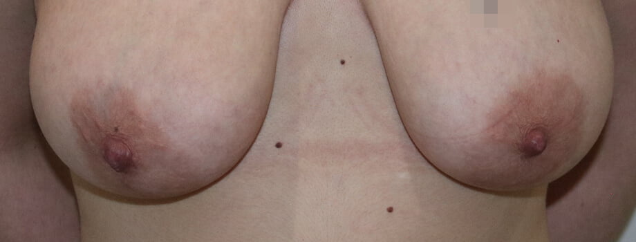 Areola reduction before