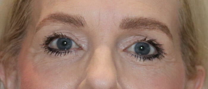 Direct brow lift upper blepharoplasty after 1