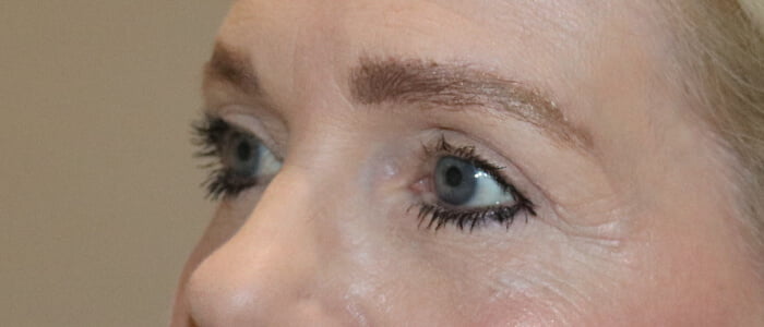 Direct brow lift upper blepharoplasty after 2