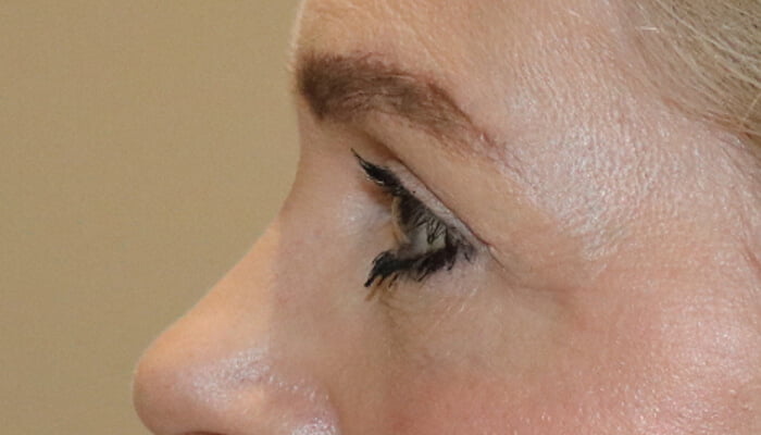 Direct brow lift upper blepharoplasty after 3