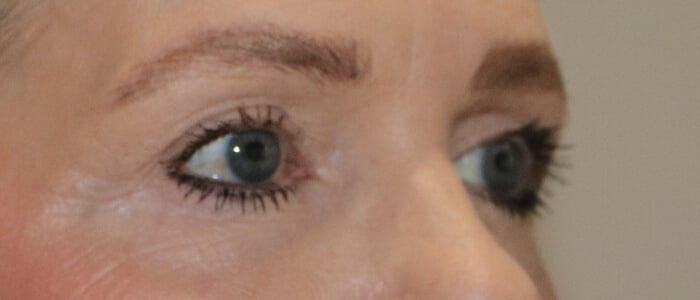 Direct brow lift upper blepharoplasty after 4