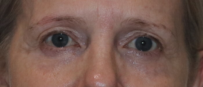Direct brow lift upper blepharoplasty before 1