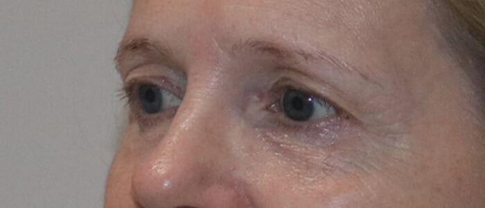 Direct brow lift upper blepharoplasty before 2