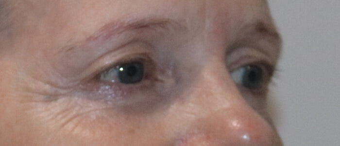 Direct brow lift upper blepharoplasty before 3
