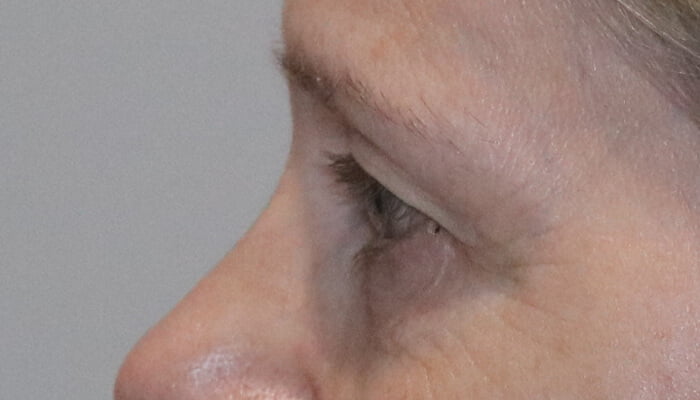 Direct brow lift upper blepharoplasty before 5