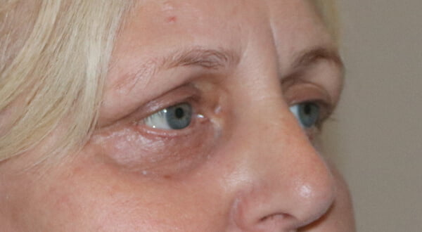 Lower eyelid TCA peel after