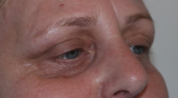 Lower eyelid TCA peel before