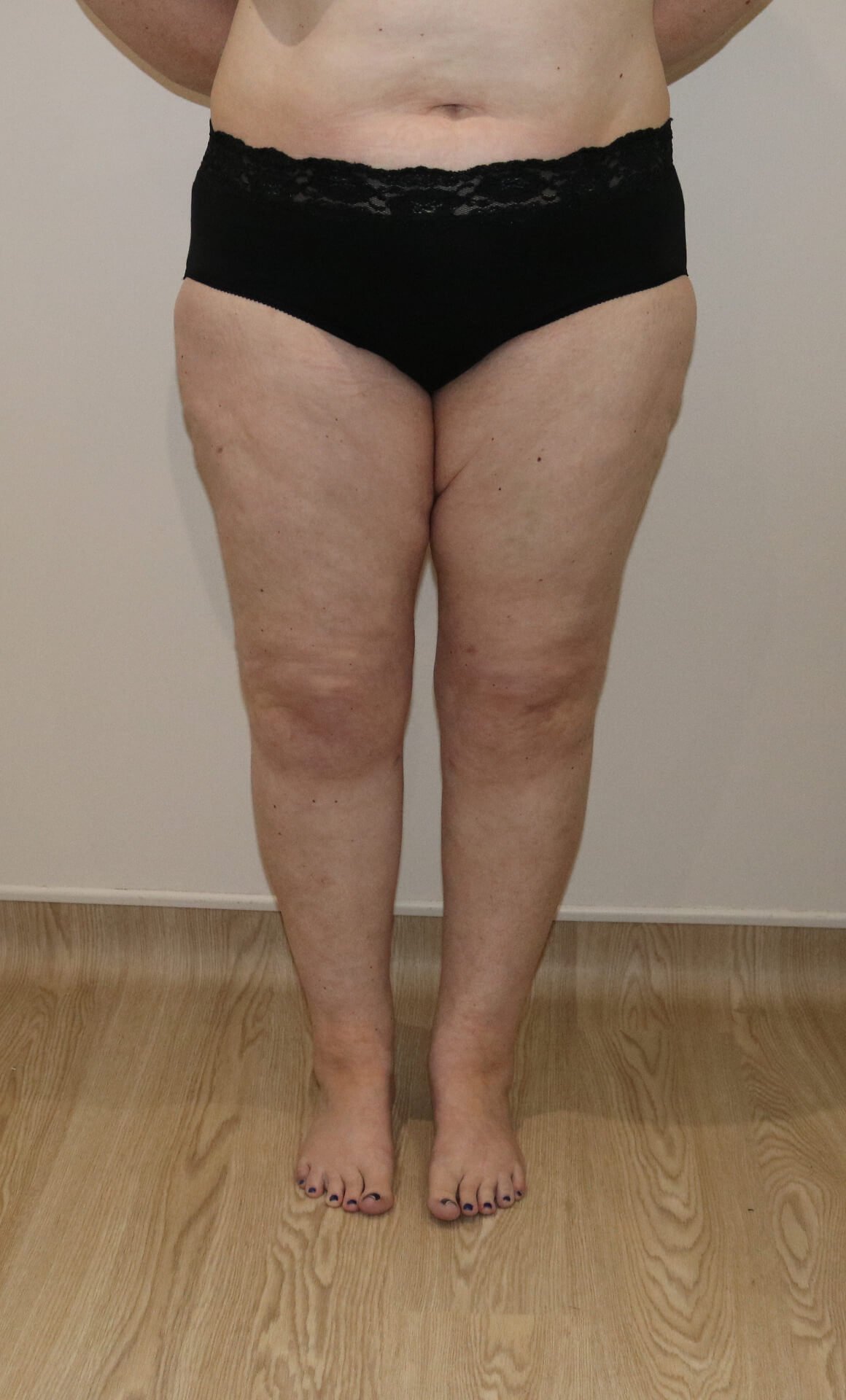 Lower limb lipoedema liposuction after AP view
