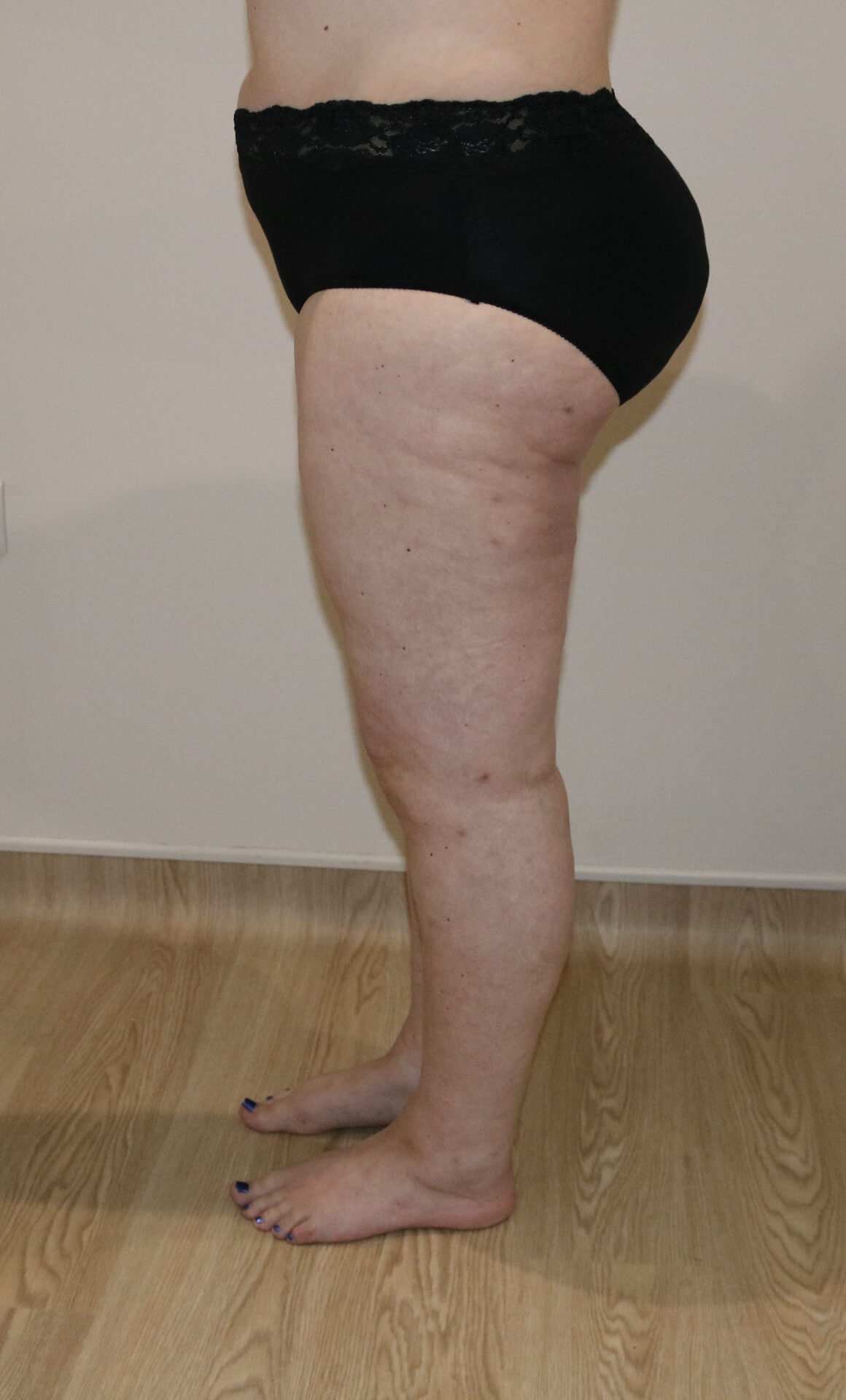 Lower limb lipoedema liposuction after left lateral view
