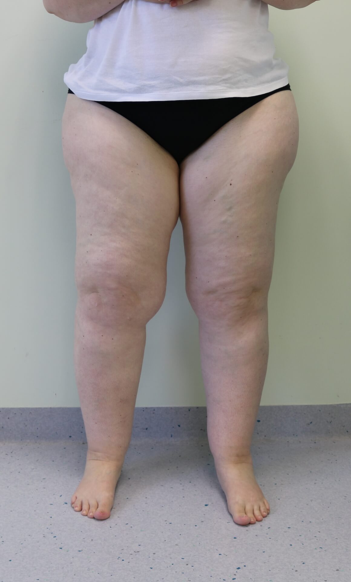 Lower limb lipoedema liposuction before AP view
