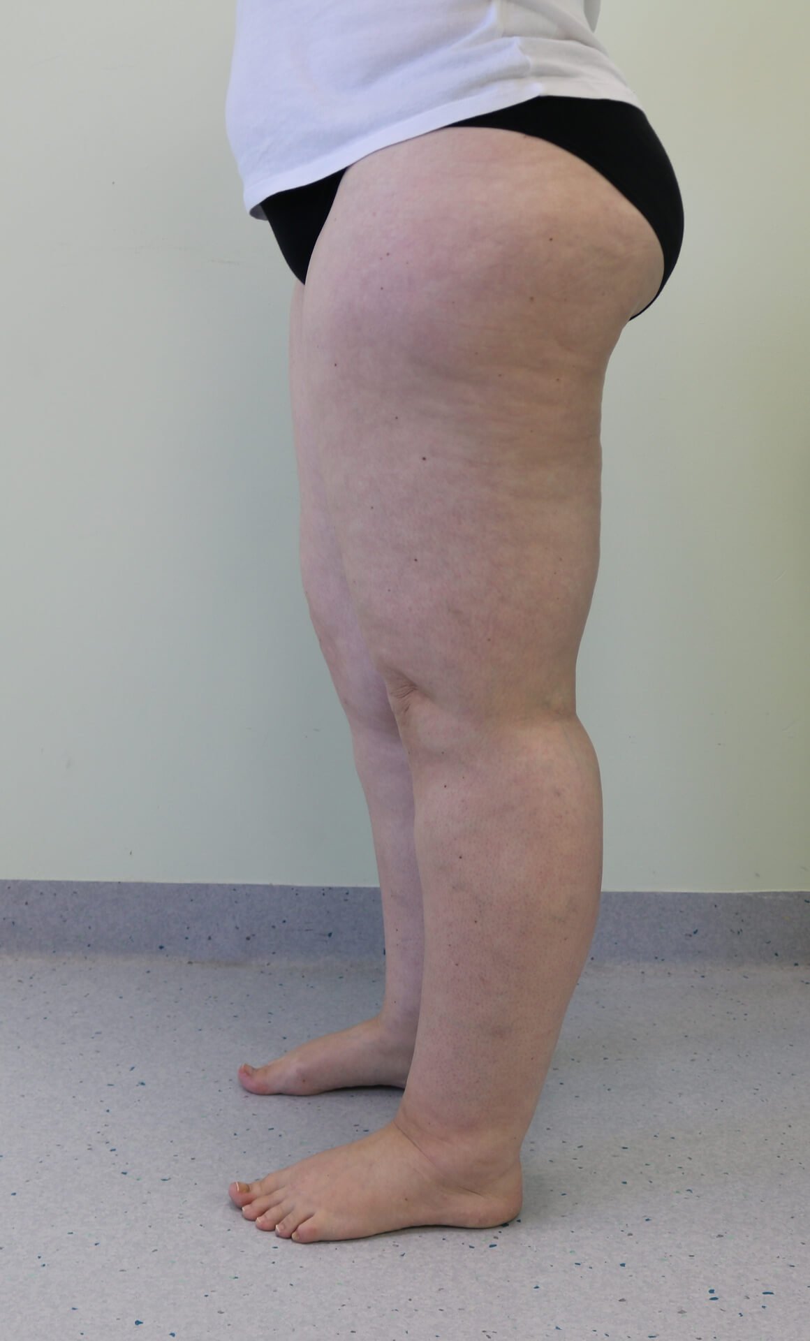 Lower limb lipoedema liposuction before left lateral view