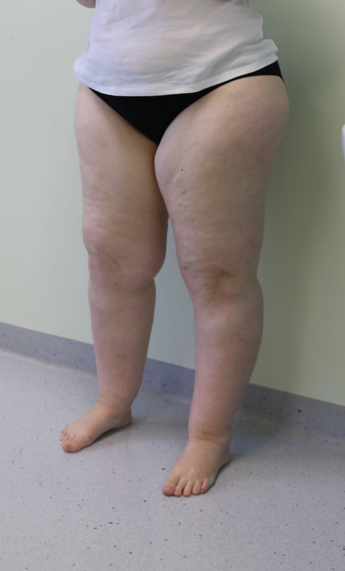 Lower limb lipoedema liposuction before left oblique view