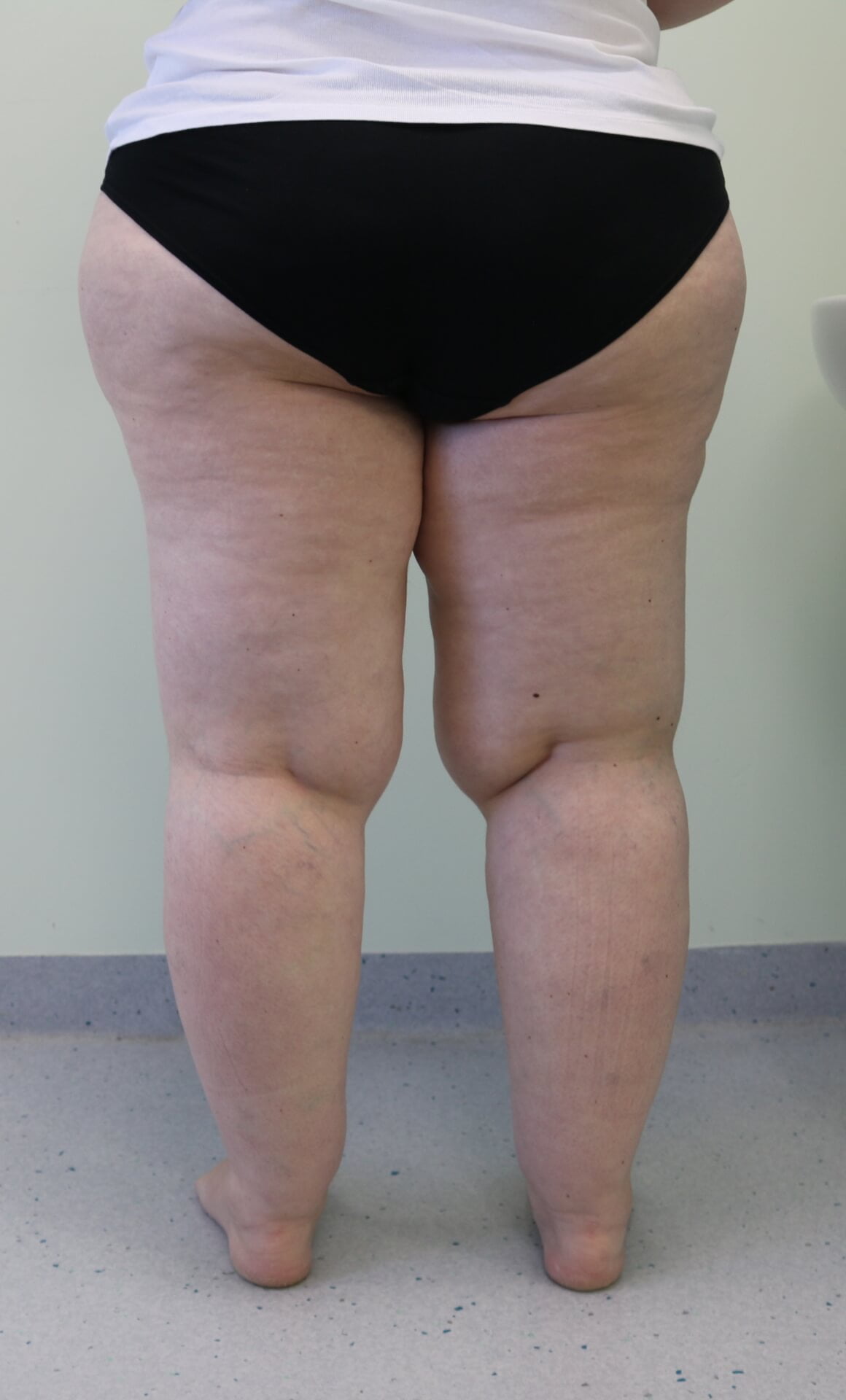 Lower limb lipoedema liposuction before posterior view