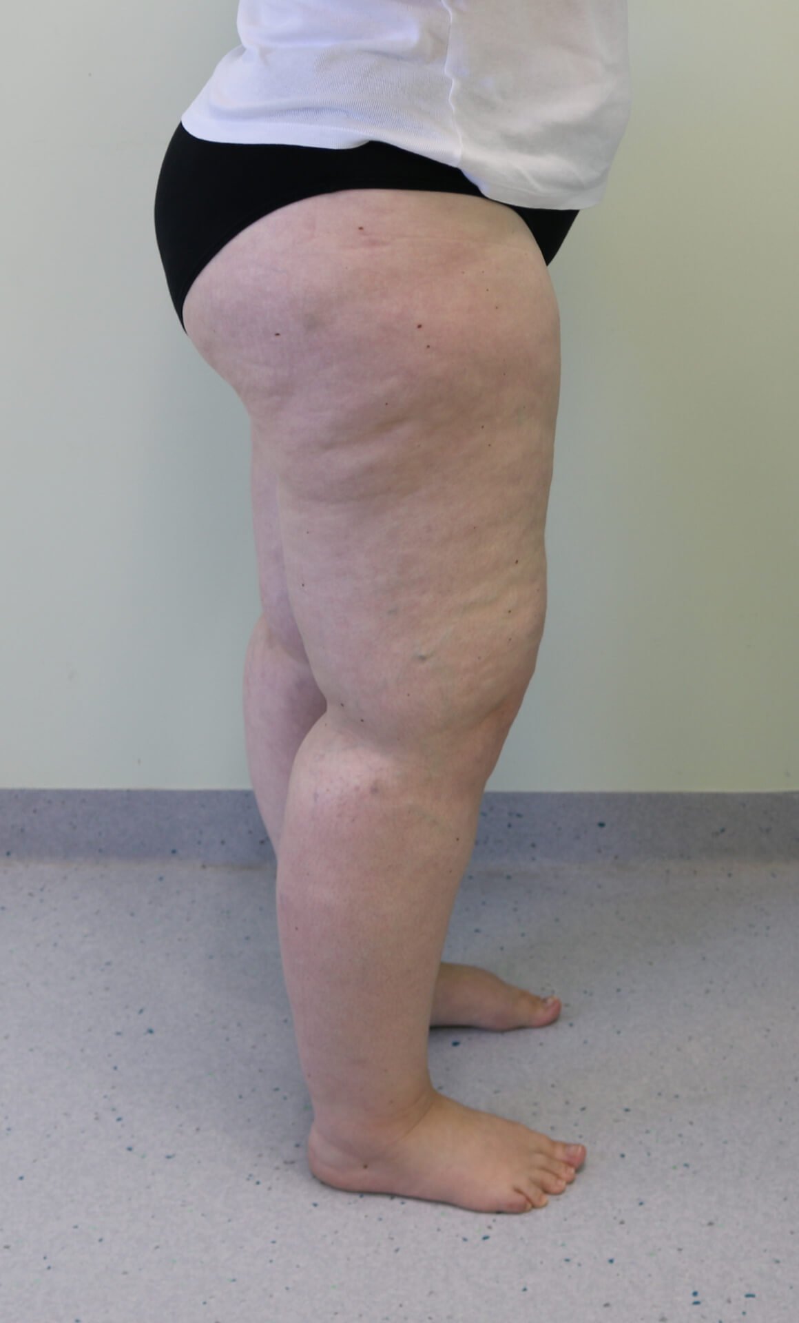 Lower limb lipoedema liposuction before right lateral view
