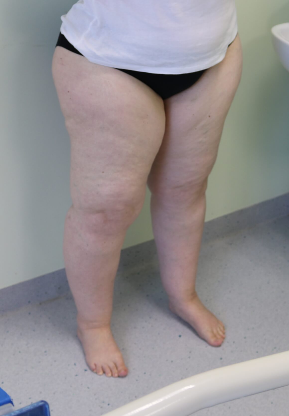 Lower limb lipoedema liposuction before right oblique view