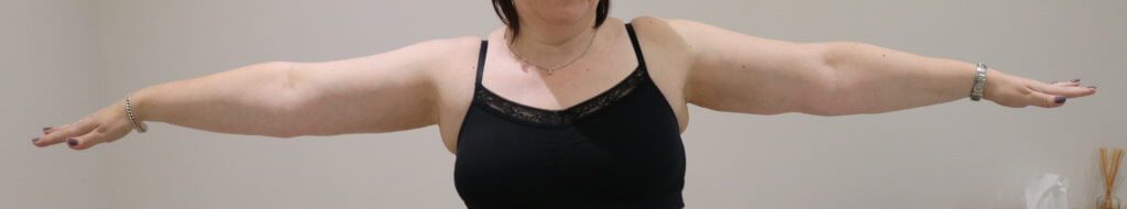 Upper limb lipoedema liposuction