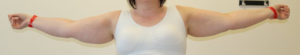 Upper limb lipoedema liposuction