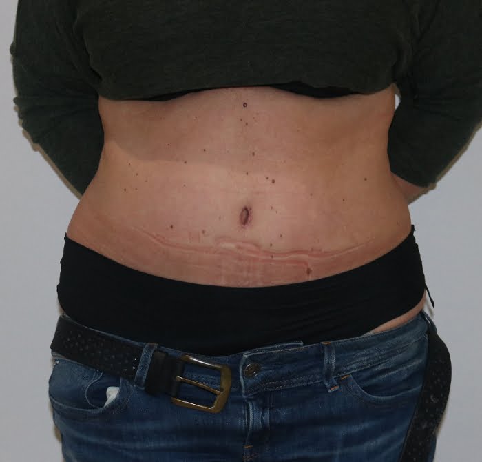 Brazilian tummy tuck after AP view 1