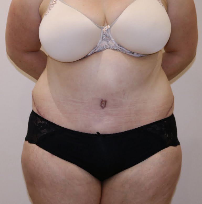 Brazilian tummy tuck after AP view 2