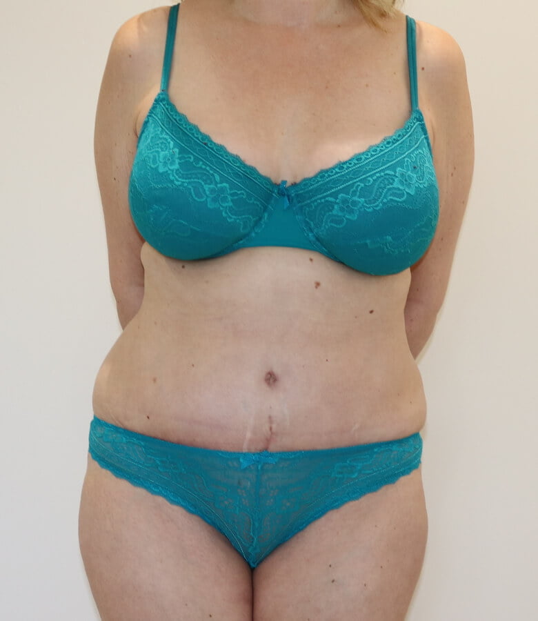 Brazilian tummy tuck after AP view