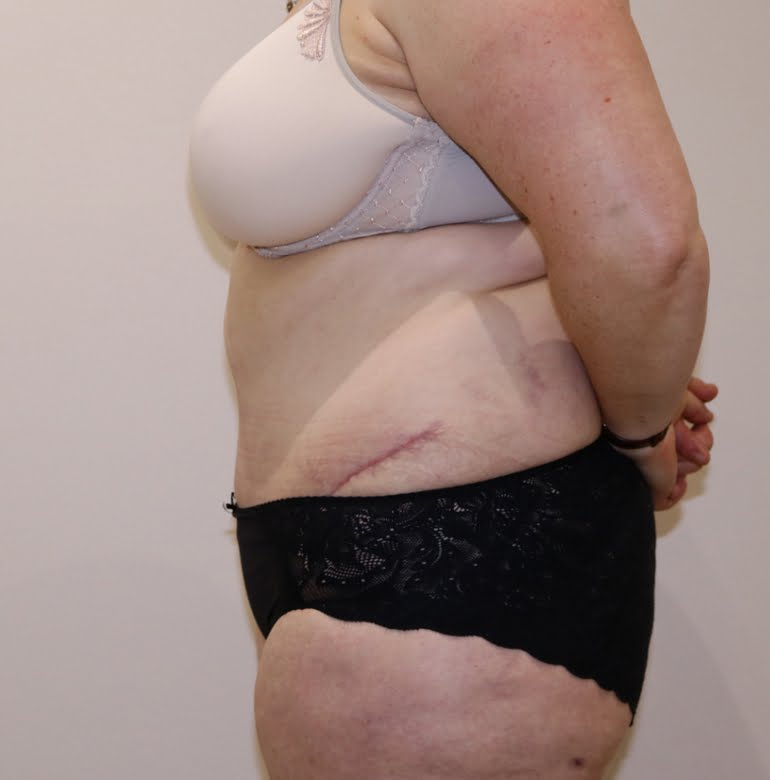 Brazilian tummy tuck after left lateral 1
