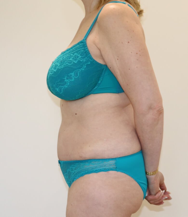 Brazilian tummy tuck after left lateral