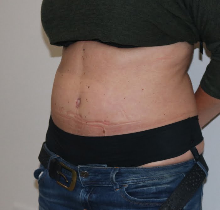 Brazilian tummy tuck after left oblique