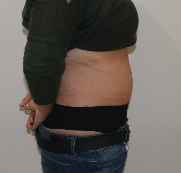 Brazilian tummy tuck after right lateral 1
