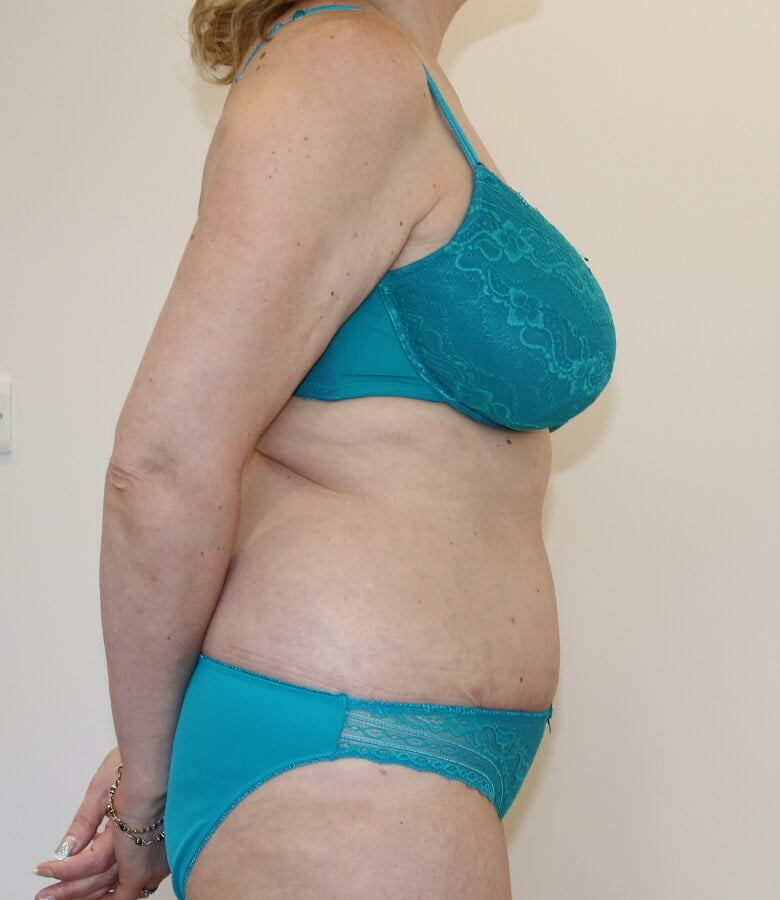 Brazilian tummy tuck after right lateral