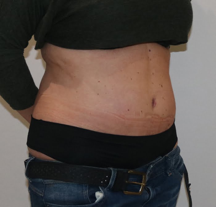 Brazilian tummy tuck after right oblique 1