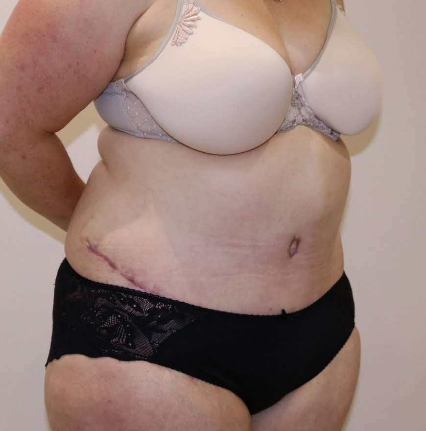 Brazilian tummy tuck after right oblique 3