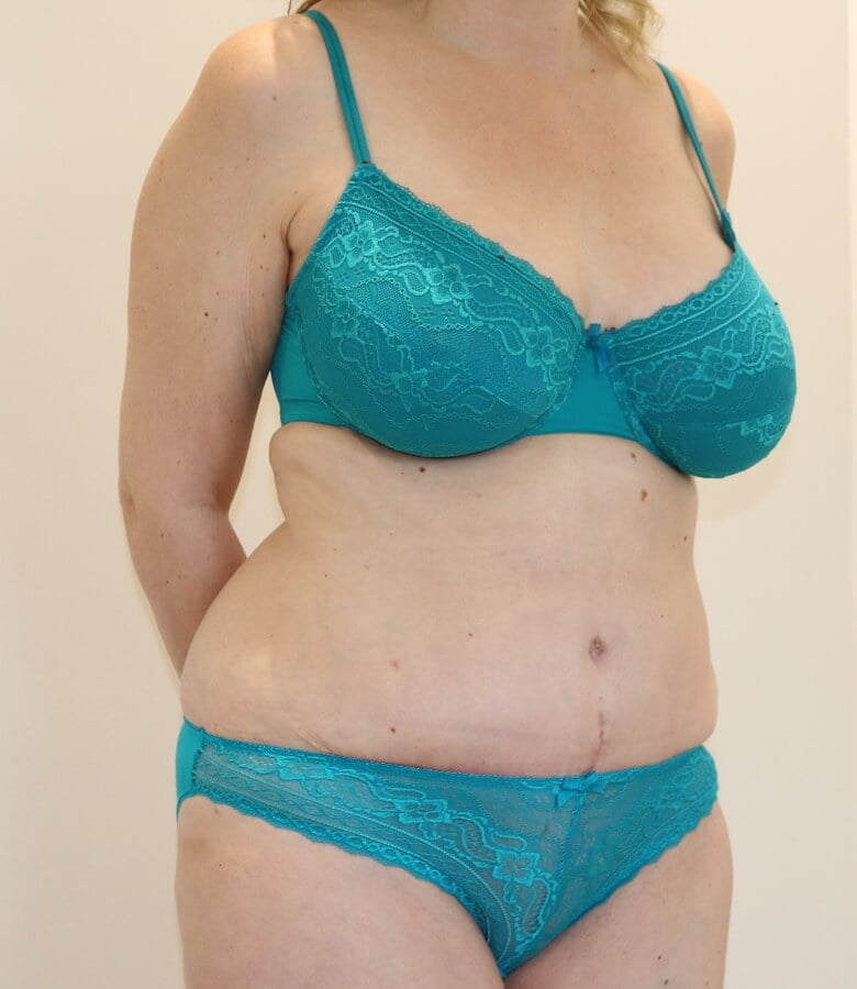 Brazilian tummy tuck after right oblique