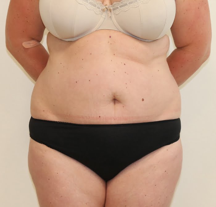 Brazilian tummy tuck before AP view 1