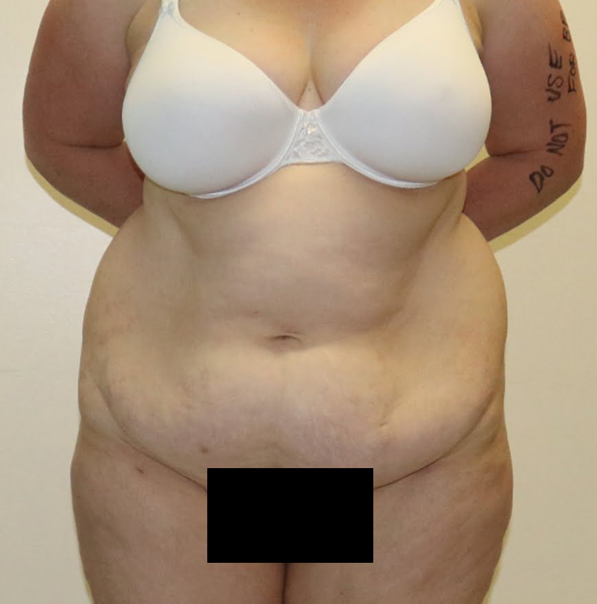 Brazilian tummy tuck before AP view 2
