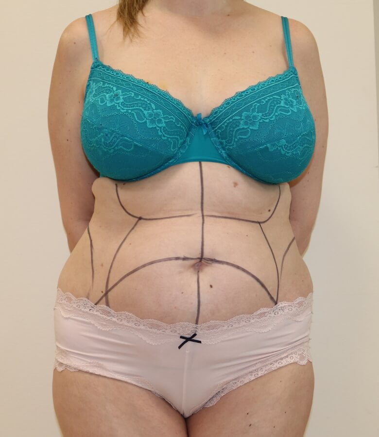 Brazilian tummy tuck before AP view