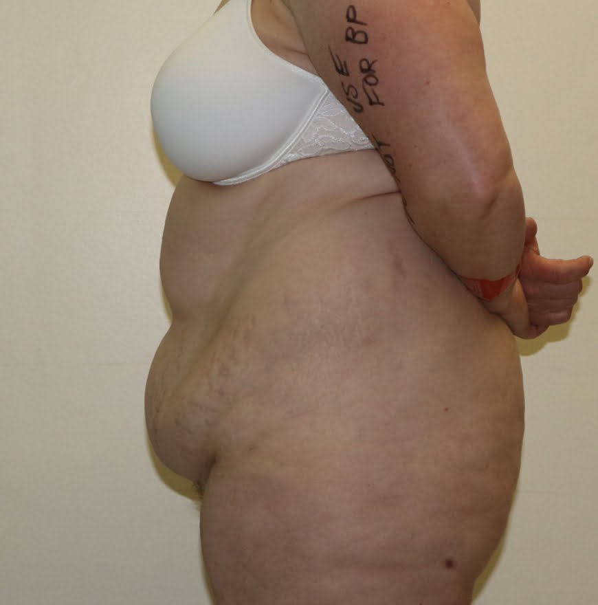 Brazilian tummy tuck before left lateral 1