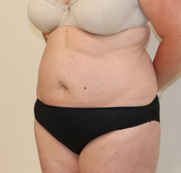 Brazilian tummy tuck before left oblique