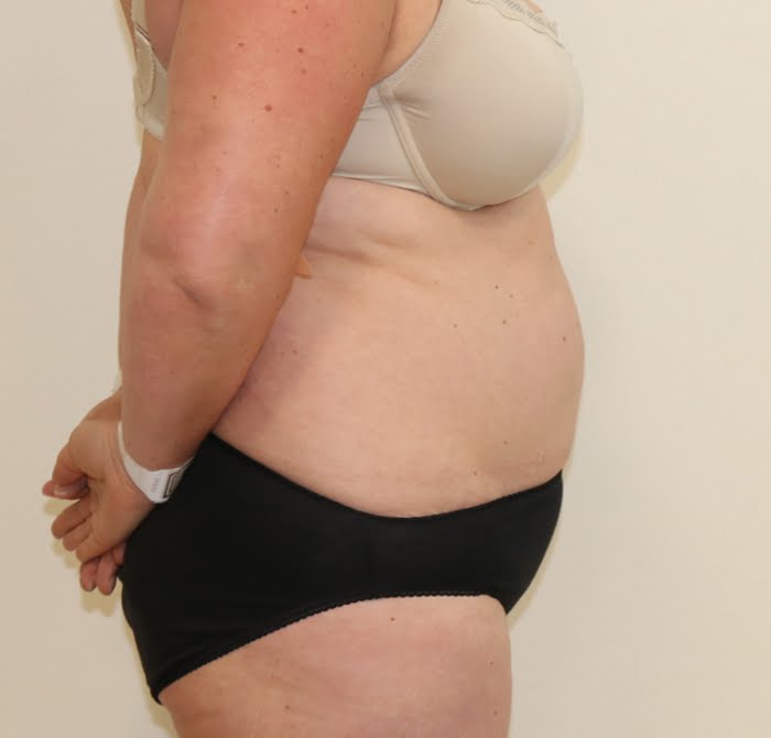 Brazilian tummy tuck before right lateral 1