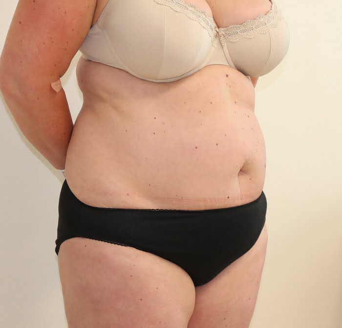 Brazilian tummy tuck before right oblique 1