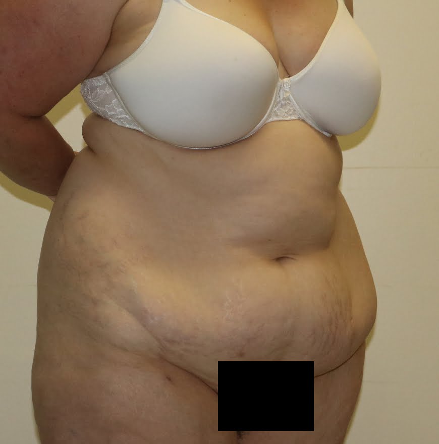 Brazilian tummy tuck before right oblique 2