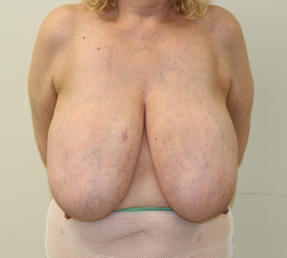 Breast reduction before AP view