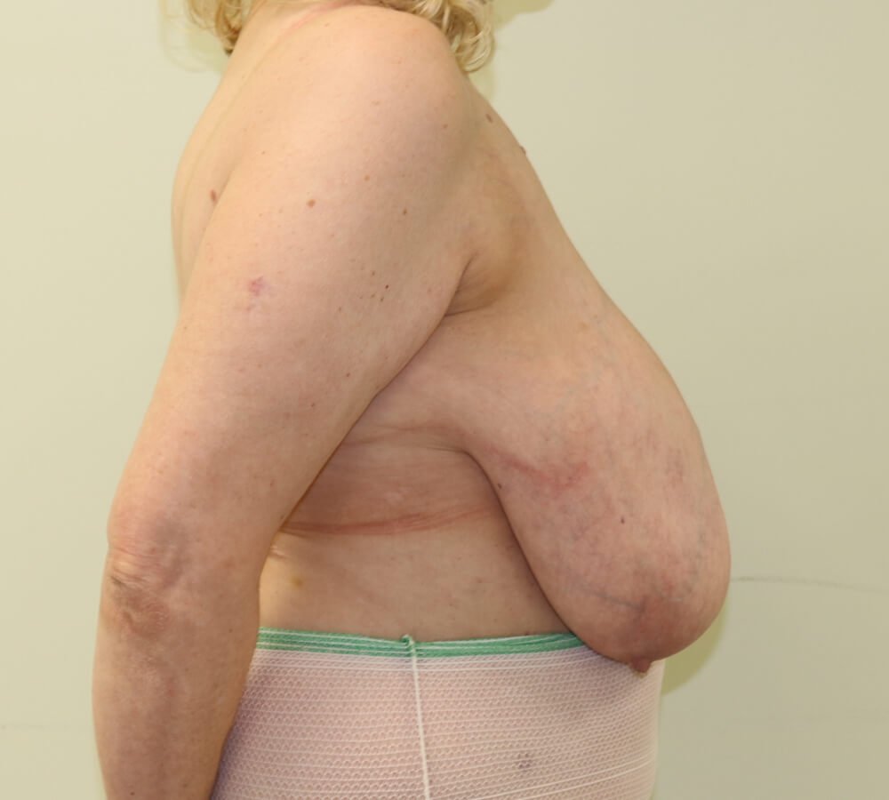 Breast reduction before right lateral