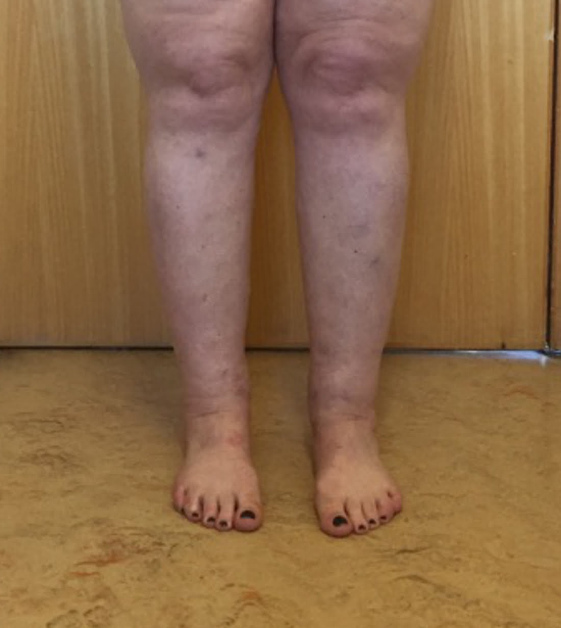 Cankles surgery after AP view 1