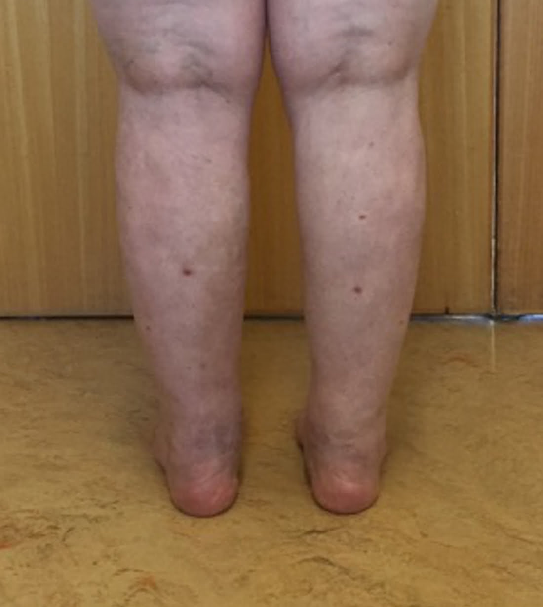 Cankles surgery after posterior view