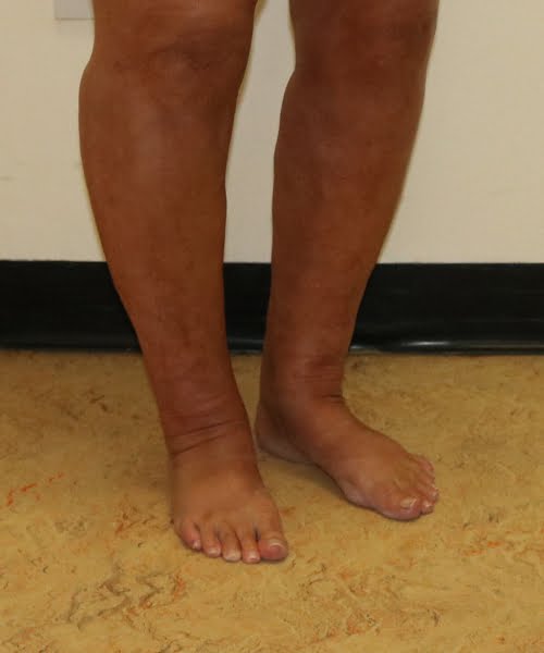 Cankles surgery after right oblique