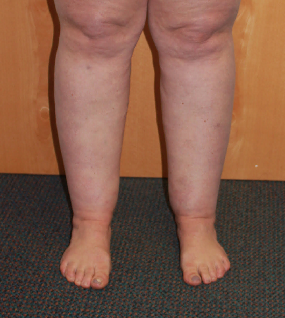 Cankles surgery before AP view 1